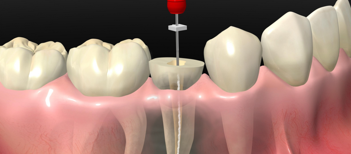 Qué es la endodoncia