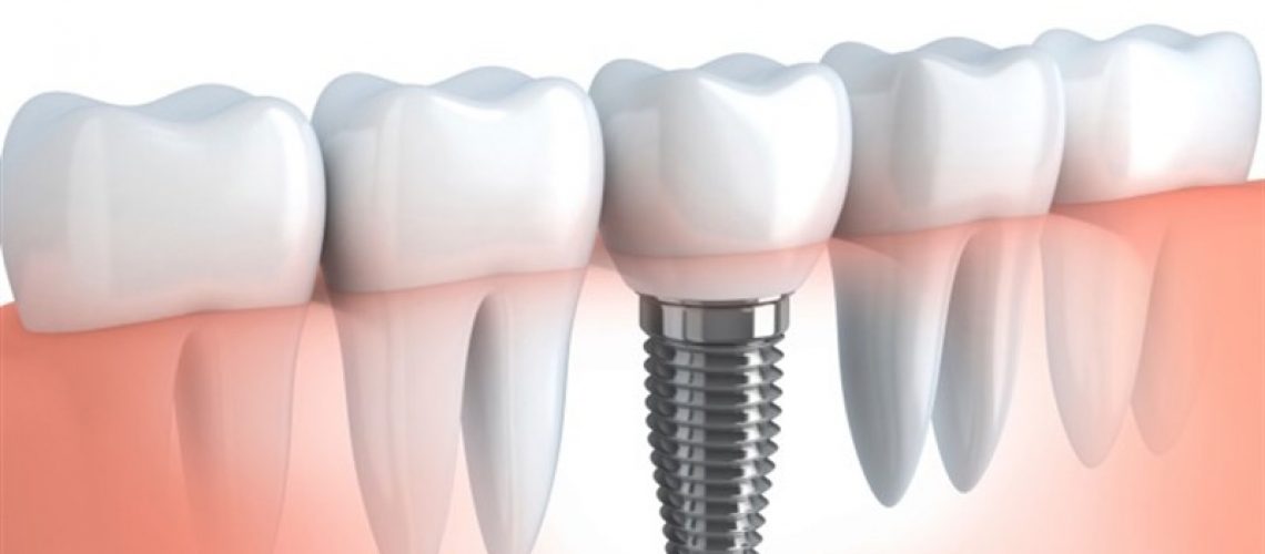 implantes-llobregat-dental-